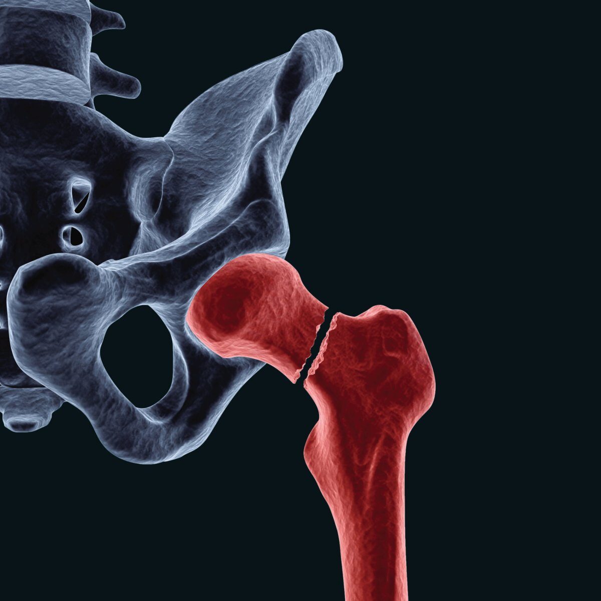 Digital medical illustration depicting a hip fracture often seen in cases of osteoporosis; intracapsular (femoral neck) fracture: a fracture of the neck of the femur.