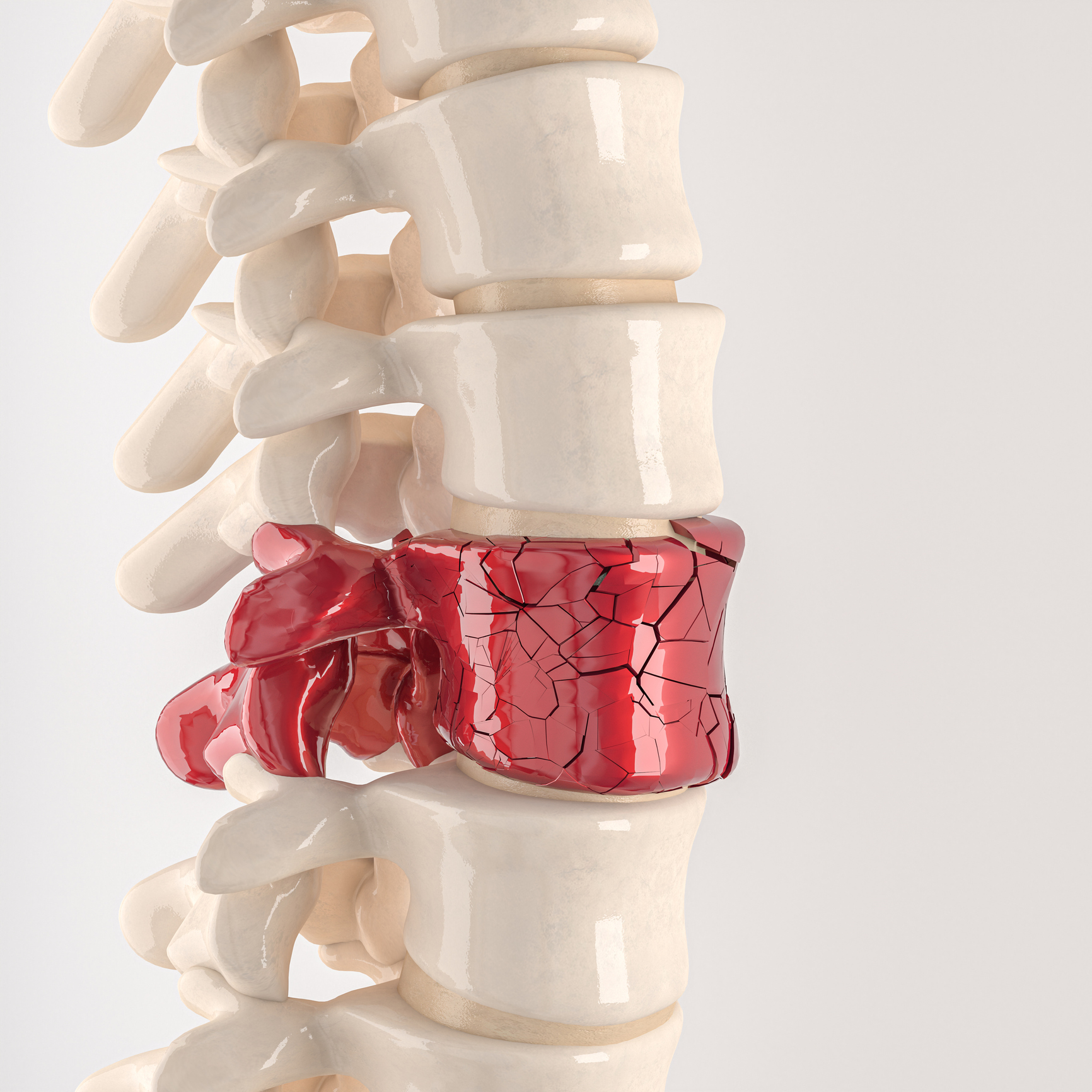 spine with shattered vertebrae. concept of physical discomfort. 3d render